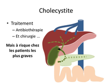 5-5 Pathologies biliaires (indispensables).mp4